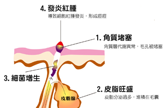 八大类痘痘治疗方法 别再折腾你的脸！